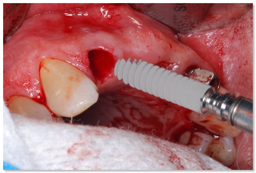  image immediate implant placement Ankylos